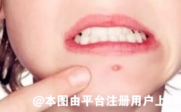 为什么痘痘不能挤 看完你就知道了