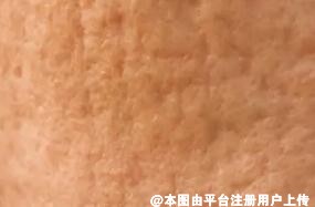 脸上痘坑太多怎么办 这4种祛痘坑的方法快保存好-32282