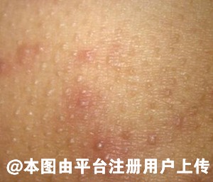 屁股长痘是怎么回事 该如何是好呢