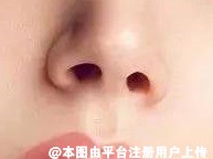 做隆鼻会有哪些方式呢 鼻综合和隆鼻有什么区别