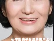 想做脂肪填充面部 这些内容得先了解