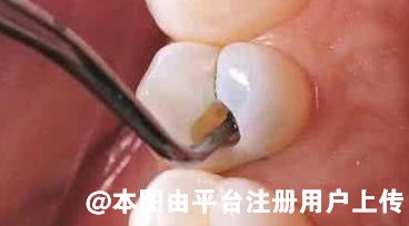 在补牙时嵌体和牙冠 哪个用的时间长一些呢