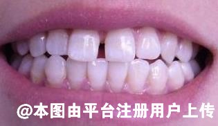 儿童想要预防牙髓炎 要做到这六点-32717