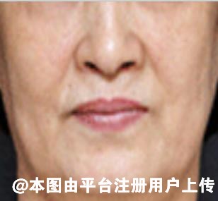 脸部凹陷填充 玻尿酸注射和脂肪填充哪个更好呢