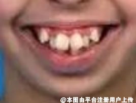 牙齿矫正拔牙一般会拔哪些牙呢
