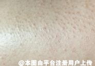 毛周角化不痛不痒却很不好看 鸡皮肤要怎么治