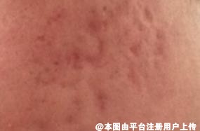 好烦哦 脸上的痘坑该怎么去掉呢