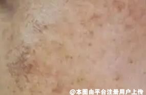 来看看斑究竟有哪些类型呢 怎么淡斑呢