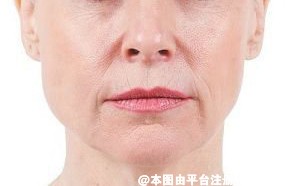 表情丰富会出现法令纹 你还敢笑吗