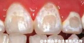 牙齿长出白色的斑块要注意了 许是牙齿脱矿了
