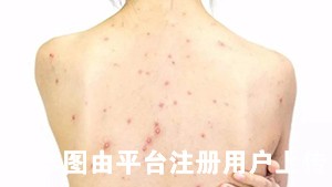 小仙女决不允许后背长痘 太影响美观了