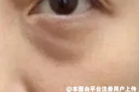哪几种情况下 眼袋会越长越严重-35769