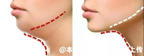 双下巴就是多肉吗 但单靠吸脂并不能解决