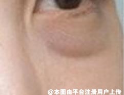 目前常见的眼袋类型有哪些 如何祛眼袋呢