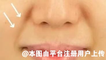 显老的法令纹 可以试试这个方法填充去除