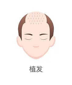 快来植发吧 美美回家过年