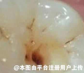 如何预防牙齿小黑点的产生