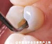 一颗牙齿烂了一半为什么不可以补牙 医生非要叫拔掉