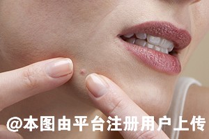 下巴长痘不是小事 叫你如何化解-36748