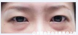祛眼袋方式怎么选 简单对比下内切和外切去眼袋的方法