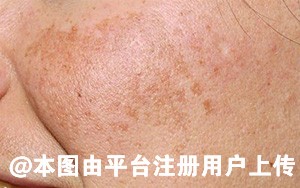 为什么天气一冷 脸上就会容易长斑-36958