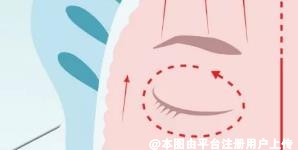注射玻尿酸后这些问题要注意 不然就白打了-37075