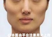 面部整形：详解高颧骨整形手术过程5步曲