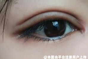 做了双眼皮显假、有肉条感 出现这些情况怎么办