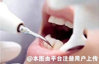 原来超声波洗牙可以让我们牙齿变白啊-37530