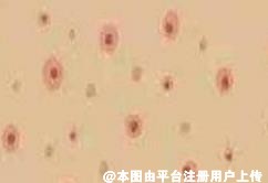 后脑勺总是长痘痘 可能是毛囊炎找上门了