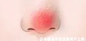 酒糟鼻按其发展过程分为三期 你都知道吗