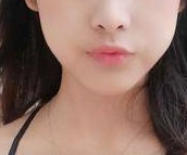 下巴其实我觉得现在看着区别不大 没有刚开始那么明显