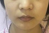 么一个小小鼻子的手术 对颜值的变化真的非常大-38286