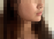 感觉做自体脂肪填充脸越来越自然了-38315