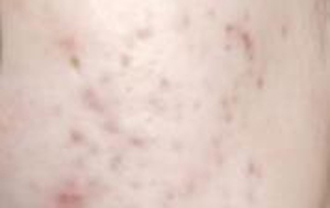 脸上有痘印痘坑 想改善微针和点阵激光哪种更好？