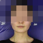 做完下颌角 人感觉年轻了几岁