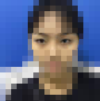 做双眼皮真的要选对好的医生-38837