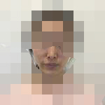 隆鼻完后 感觉脸变得精致起来