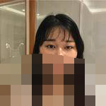 做完双眼皮后 发现是真的香