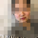 隆鼻后 人显得年轻了不少