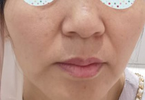 为光子嫩肤疯狂打call的年轻人