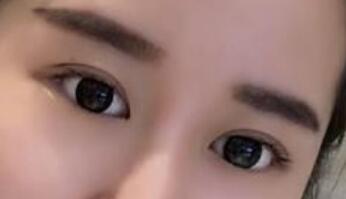 做双眼皮手术后，这是我的理想状态！