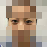 做完双眼皮 眼睛变得好看不行-40185
