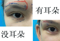 职场32岁的我 居然用了10支婕尔玻尿酸来丰耳朵