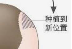 植发问题：很多人想植发但是不知道植发是好处多还是坏处多？