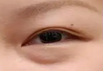 吸脂去眼袋手术价格详情介绍