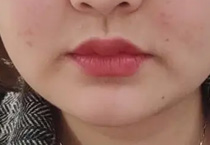 这个七夕，邂逅另爱美人士心动的一个医美项目