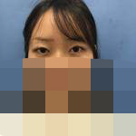 做完双眼皮 肉眼可见的美起来-40889