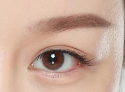 做完双眼皮 宛如开了大眼特效