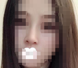鼻子比我的想象更快 耳软骨隆鼻很自然-41266